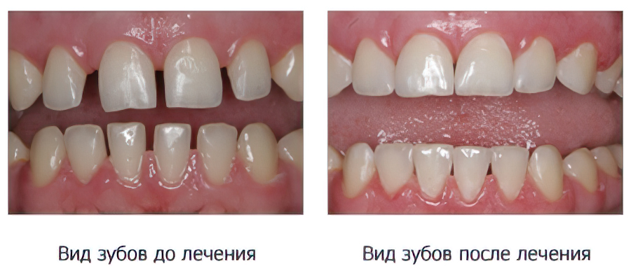 Реставрация зубов Томск Аникинский 2-й